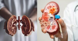   (Kidney ) 